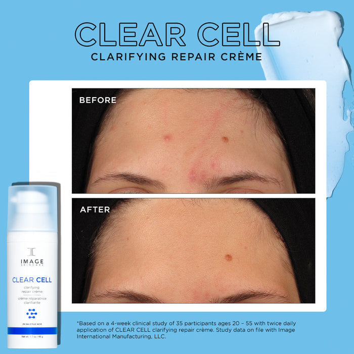 Before and after comparison showing reduced forehead blemishes and clearer skin using CLEAR CELL clarifying repair crème | IMAGE Skincare for skincare improvement.