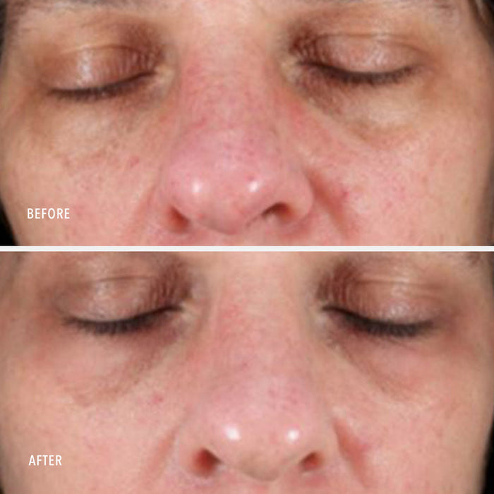 Before and after close-up images of a person's face showing reduced redness and improved skin tone after using Nimni Cream .5 oz | HydroPeptide for skincare.