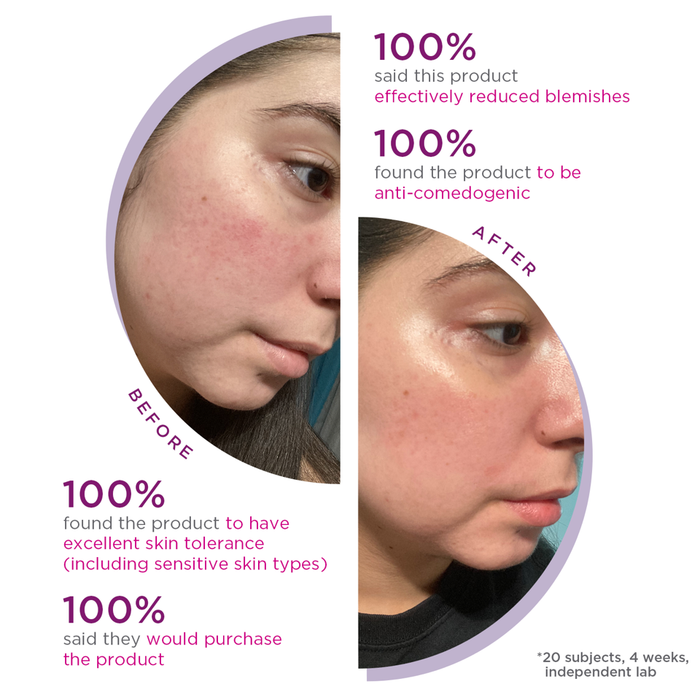 Before and after close-up images of a woman's cheek showing improved skin clarity and reduced blemishes after using Kantic® Light Clarifying Cream | Alchimie Forever, with text highlighting user satisfaction and product benefits for sensitive skin.
