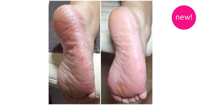 LovaSkin Instant Foot Peel (500ml)