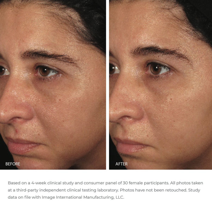Before and after comparison showing improved skin texture and hydration on a woman's face after using ORMEDIC balancing biopeptide crème | IMAGE Skincare for four weeks, highlighting skincare benefits.